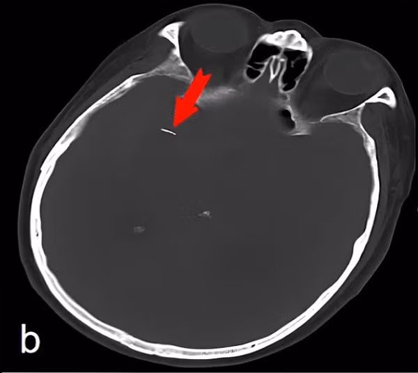 Nguoi dan ong co chiec kim trong nao suot 20 nam ma khong biet