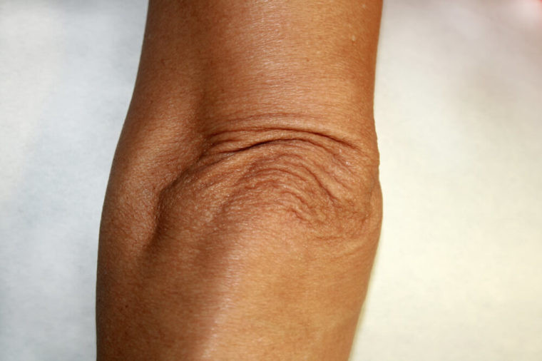 Khuỷu tay: Giống như đầu gối, khuỷu tay chủ yếu là xương, không có mỡ và cơ bắp để làm cho chúng đầy đặn. Mọi người có xu hướng chống khuỷu tay khiến trọng lượng gây thêm căng thẳng cho bộ phận này. Sử dụng kem dưỡng ẩm với axit salicylic hoặc urê có thể làm trẻ hóa khuỷu tay.