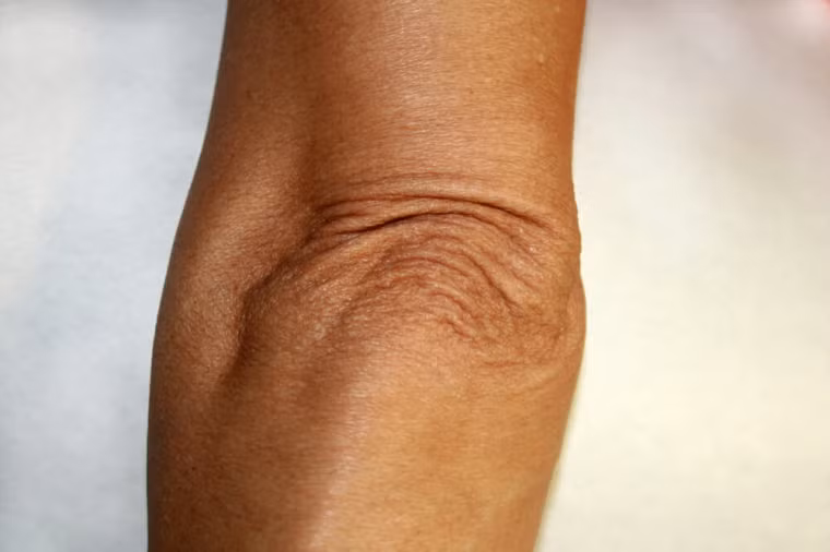 Khuỷu tay: Giống như đầu gối, khuỷu tay chủ yếu là xương, không có mỡ và cơ bắp để làm cho chúng đầy đặn. Mọi người có xu hướng chống khuỷu tay khiến trọng lượng gây thêm căng thẳng cho bộ phận này. Sử dụng kem dưỡng ẩm với axit salicylic hoặc urê có thể làm trẻ hóa khuỷu tay.