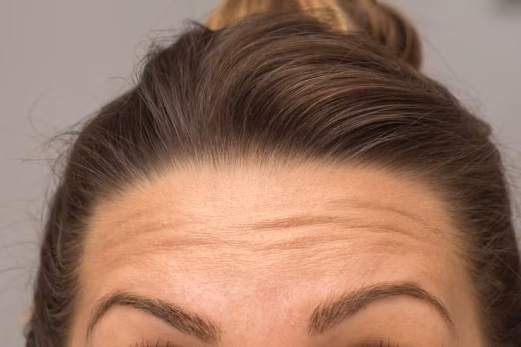 Trán: Trán cũng có thể là một trong những nơi đầu tiên trên khuôn mặt phát triển các nếp nhăn. Các sản phẩm có chứa retinol làm tăng collagen để giảm nếp nhăn, cộng với tẩy da chết có thể làm cho làn da của bạn trông sáng hơn và mềm mại hơn.