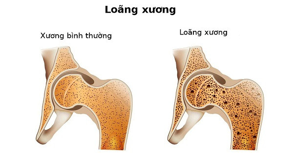 Đáng lưu ý, kết quả nghiên cứu từng chỉ ra, mật độ dự trữ canxi của xương diễn ra mạnh trong độ tuổi từ 22-35, đạt đỉnh ở tuổi 35. Nếu nguồn dự trữ không nhiều, cơ thể sẽ sớm đối diện tình trạng loãng xương.