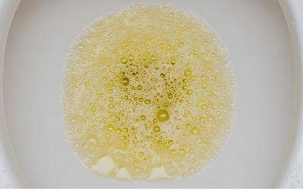 Nước tiểu có bọt. Nước tiểu người khỏe mạnh cơ bản không có bọt. Ngược lại, nếu nước tiểu chứa nhiều bọt, bọt để lâu không tan thì cần nghi ngờ có protein niệu. Protein niệu liên quan mật thiết tình trạng mất protein sau khi thận tổn thương, thay đổi thành phần nước tiểu và lượng protein dư thừa.