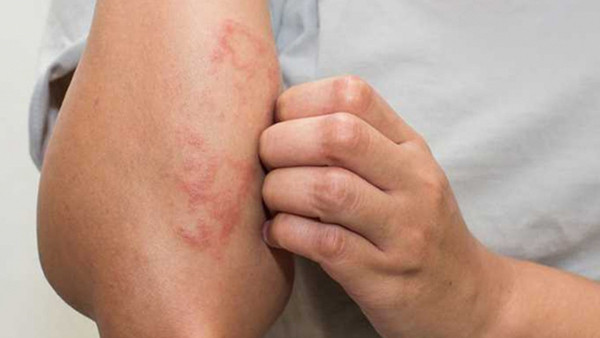 Độc tố tích tụ ngày càng nhiều khiến các mô da bị kích thích, thường xuyên ngứa ngáy. Đáng lưu ý, ngứa da do bệnh thận thường bị nhầm lẫn với các bệnh ngoài da thông thường. Vậy nên, bạn cần lắng nghe cơ thể để phát hiện các dấu hiệu nhiễm độc niệu khác, tránh bỏ sót gây nguy hiểm.