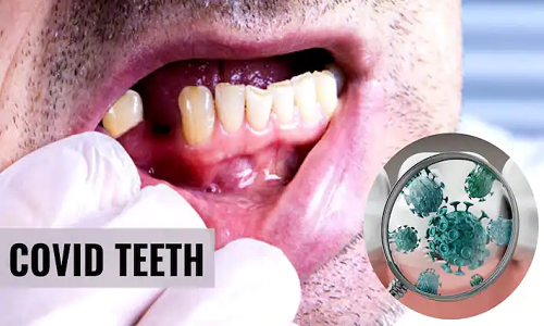 Bất ngờ dấu hiệu ở miệng cảnh báo bạn mắc COVID-19 Bat ngo dau hieu o mieng canh bao ban mac COVID-19