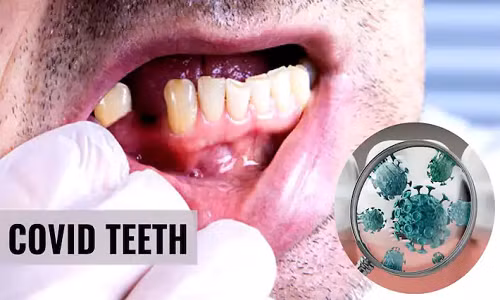 Bat ngo dau hieu o mieng canh bao ban mac COVID-19