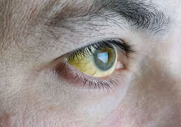 Ngứa mắt. Thường xuyên gặp tình trạng mắt mỏi và khô, ngứa không rõ lí do thì rất có thể đây là một trong những dấu hiệu bệnh gan, bao gồm ung thư gan.