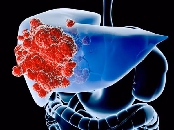 Để xác định đó là do các vấn đề về gan gây ra, bạn cần chú ý thêm các dấu hiệu ung thư gan khác. Trung Y nhấn mạnh, gan bị tổn thương sẽ phát ra các “tín hiệu SOS” dưới đây, bạn cần hết sức chú ý.