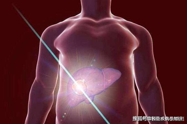 Theo báo cáo ghi nhận ung thư toàn cầu (GLOBOCAN) năm 2018, thế giới mỗi năm có khoảng 841.000 ca mắc mới ung thư gan và 781.000 người tử vong vì căn bệnh này. Ung thư gan được xem là loại ung thư gây tử vong hàng đầu. Bệnh thường được phát hiện muộn, làm giảm hiệu quả quá trình điều trị. (Ảnh: Sohu, minh họa)