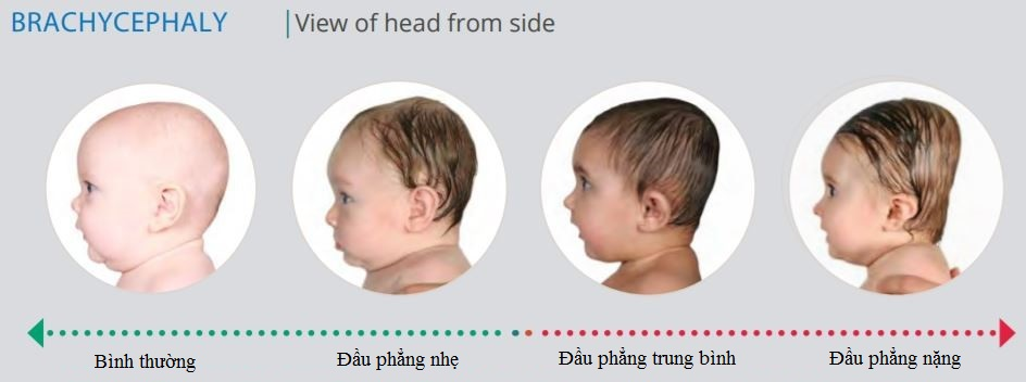 Hầu hết trường hợp hội chứng đầu phẳng không gây vấn đề sức khỏe nghiêm trọng vì không ảnh hưởng tới não. Tuy vậy, trường hợp đầu phẳng mức độ trung bình, nặng có thể gây một số vấn đề sức khoẻ như loạn thị, chậm phát triển, khó ăn, khó học tập, khó nói, mất tầm nhìn, nguy cơ nghe kém, rối loạn chức năng khớp hàm dưới, động kinh, vẹo cột sống,...