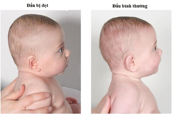 Nguyên nhân phổ biến gây hội chứng đầu phẳng là duy trì một tư thế ngủ trong thời gian dài. Dưới đây là những tư thế ngủ có thể khiến đầu trẻ biến dạng.
