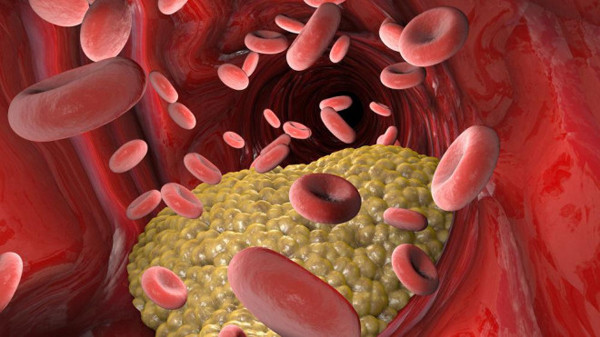 Người có người thân trong gia đình mắc các bệnh tim mạch, mỡ máu.