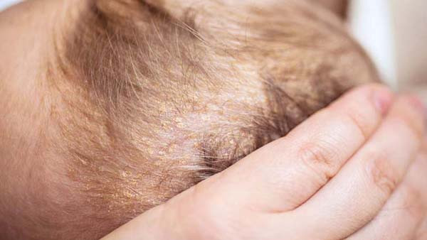 Trường hợp vùng thóp chứa nhiều mảng cứng, bết, bạn có thể dùng khăn ấm đắp lên ít phút rồi lau sạch. Nước ấm ngấm vào mảng cứng giúp chúng dễ bong ra hơn, tránh gây tổn thương cho bé.