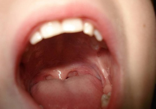 Thay dom tren luoi tuong benh tinh duc, ai ngo ung thu