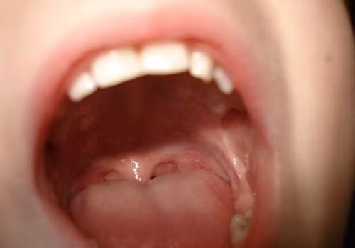 Thay dom tren luoi tuong benh tinh duc, ai ngo ung thu