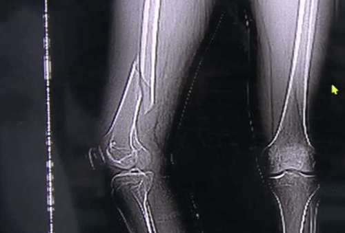 Tap yoga kieu nay, thanh nien suyt liet luon chan