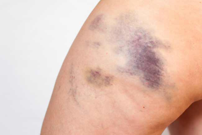 Bệnh rối loạn đông máu (Hemophilia): Trái ngược với huyết khối tĩnh mạch sâu, rối loạn đông máu gây chảy máu hoặc bầm tím nghiêm trọng và không rõ nguyên nhân. Điều này là do thiếu các protein đông máu hoặc các nhân tố đông máu, dẫn đến đình trệ quá trình đông máu.