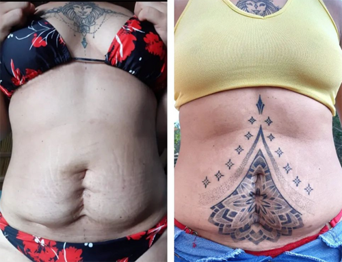 Người phụ nữ này từng trải qua cuộc đại phẫu, để lại vết sẹo lõm cực lớn trên bụng. Để giúp cô trở nên tự tin hơn, nghệ sĩ đã dành 6 giờ làm việc liên tục. Kết quả ngoài mong đợi, hình xăm không chỉ che đi vết sẹo mà còn rất hài hòa với hình xăm ở rãnh ngực trước đó.