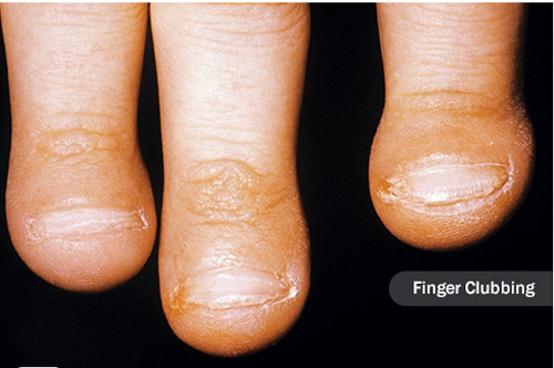 Ngón tay dùi trống. Quá trình phát triển, một số khối u phổi tạo ra chất giống như hormone. Những hormone này có thể đẩy máu và chất lỏng đến các mô đầu ngón tay, khiến chúng trở nên múp và dày hơn bình thường. (Ảnh: Webmd)