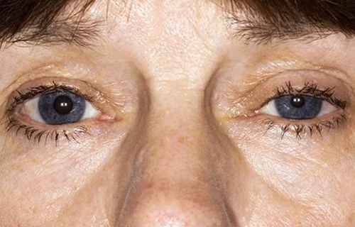 Các vấn đề về mắt. Các khối u Pancoast cũng có thể ảnh hưởng đến dây thần kinh ở mắt và một phần khuôn mặt. Nó được gọi là hội chứng Horner. Người bệnh có dấu hiệu sụp mí mắt, đồng tử nhỏ ở một bên mắt, đổ mồ hôi nhiều. Ung thư phổi tế bào nhỏ khiến cho hệ thống miễn dịch chống lại hệ thống thần kinh thị giác của bạn và nó có thể gây ra biểu hiện khó nhìn.