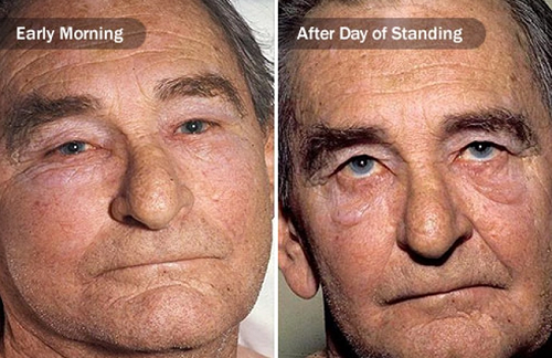 Mặt, cổ hoặc cánh tay sưng to bất thường. Tĩnh mạch chủ trên bị khối u làm tắc nghẽn, máu từ các phần trên cơ thể sẽ không thể đến các bộ phận khác, gây tắc nghẽn. Lúc này, cổ, cánh tay và mặt sẽ sưng phù vì chất lỏng trong mạch máu khu vực đó tăng.