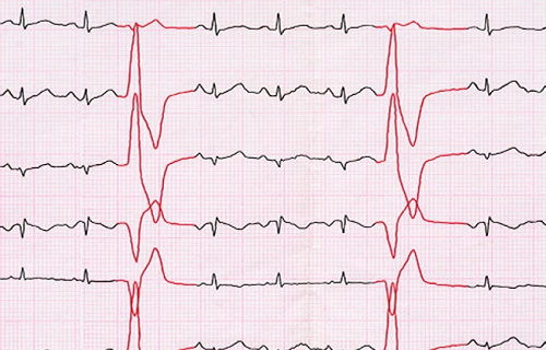 Vấn đề tim mạch. Tăng canxi máu và thiếu máu đều có thể gây ra các triệu chứng như nhịp tim nhanh hoặc không đều. Nếu vấn đề do tăng canxi máu, tình trạng có thể nghiêm trọng hơn. Bệnh nhân dễ đối diện cơn đau tim, thậm chí hôn mê. Trong khi đó, thiếu máu có thể gây đau ngực và khó thở.