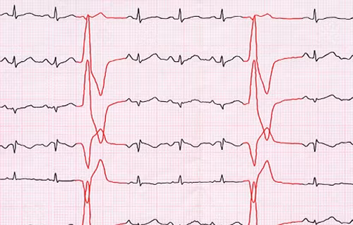 Vấn đề tim mạch. Tăng canxi máu và thiếu máu đều có thể gây ra các triệu chứng như nhịp tim nhanh hoặc không đều. Nếu vấn đề do tăng canxi máu, tình trạng có thể nghiêm trọng hơn. Bệnh nhân dễ đối diện cơn đau tim, thậm chí hôn mê. Trong khi đó, thiếu máu có thể gây đau ngực và khó thở.