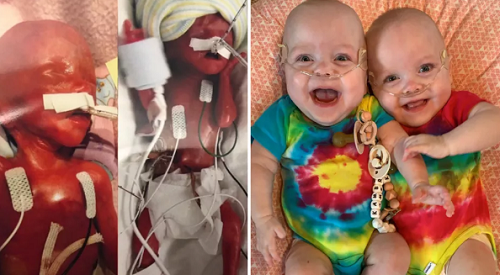 5. Cặp sinh đôi sinh non nhất thế giới. Kỷ lục cặp đôi sinh non nhất thế giới thuộc về 2 bé Keeley và Kambry Ewoldt (Iowa, Mỹ). Các em được sinh ra khi bào thai mới được 22 tuần. Trọng lượng khi sinh của 2 chị em lần lượt là 490g và 379g.