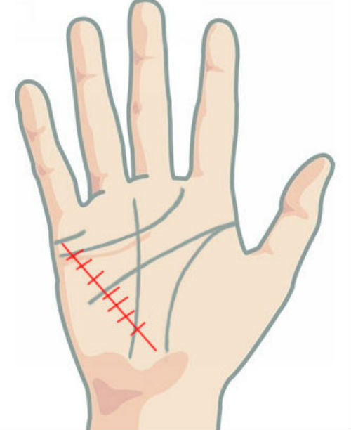 Đường chỉ tay sức khỏe bị nhiều đường cắt ngang là dấu hiệu chủ nhân có sức khỏe không tốt, dễ gặp tai nạn.