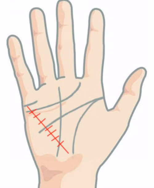 Đường chỉ tay sức khỏe bị nhiều đường cắt ngang là dấu hiệu chủ nhân có sức khỏe không tốt, dễ gặp tai nạn.