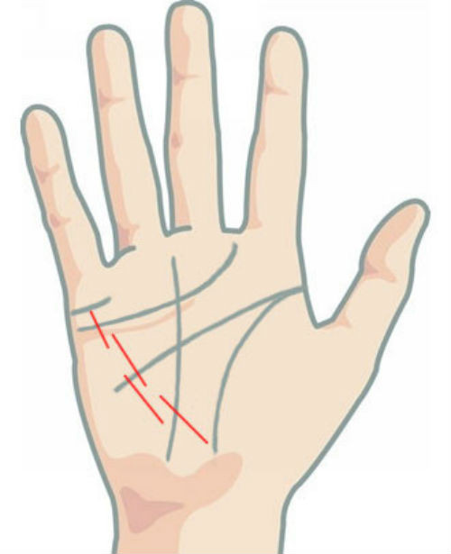 Người sở hữu đường sức khỏe ngắn hoặc tách thành nhiều đoạn ngắn là tướng người hay ốm yếu, bệnh tật.