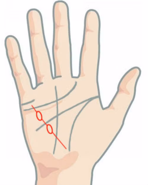 Những hình mắt xích lớn rất có thể là biểu hiện của bệnh tăng sản tuyến vú ở phụ nữ.