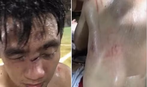  Đánh nhau nhập viện vì mâu thuẫn khi đá bóng: Ngày 16/7/2019, 2 đội bóng tự do hẹn nhau giao lưu bóng đá tại sân bóng ở số 104 Nguyễn An Ninh, Hà Nội. Một đội bóng tự do có khoảng 15 người, trong đó có một số người xăm trổ; đội còn lại có khoảng 10 người là sinh viên cùng một số người đang làm việc tại Hà Nội. Khi tranh chấp bóng, giữa 2 thành viên của 2 đội đã xảy ra va chạm. Lúc này, đội bóng có một số nam thanh niên xăm trổ đã lao vào đánh hội đồng đối thủ đội bạn. Các thành viên trong nhóm bị hại đã lao vào can ngăn nhưng cũng bị đội bóng “xăm trổ” hành hung. Đội bị hại có 1 thành viên bị thương nặng được đưa đi cấp cứu, các thành viên còn lại bị thương nhẹ. (Ảnh: Infonet) 