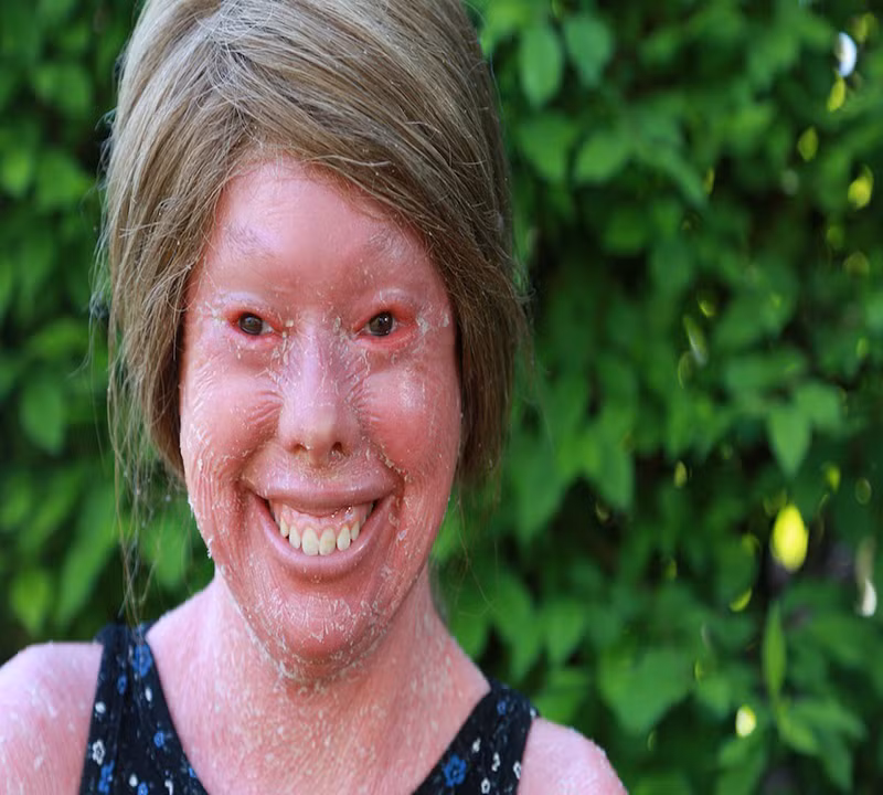 Hunter Steinitz mắc chứng bệnh rất hiếm gặp về da mang tên Harlequin ichthyosis khiến cô cảm thấy rất đau đớn. Ảnh: PL.