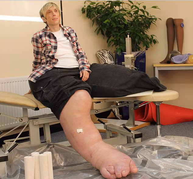 Mandy Sellars, 41 tuổi, là người phụ nữ sở hữu đôi chân nặng nhất và lớn nhất trên thế giới. Mandy Sellars mắc phải hội chứng Proteus khiến đôi chân của cô nặng tới 108 kg. Ảnh: PL.