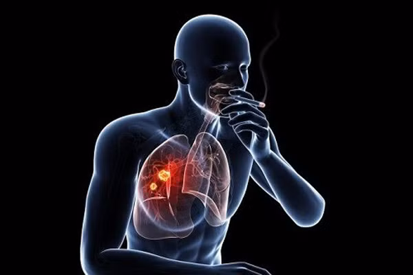 Lý giải điều này, các nhà khoa học cho rằng những yếu tố bên ngoài như hút thuốc lá, sống trong môi trường chứa chất độc hại ảnh hưởng tiêu cực đến chức năng phổi, làm tăng nguy cơ mắc ung thư. (Ảnh minh họa)