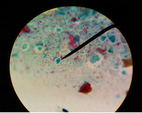 Cách đây không lâu, anh Ngô (Phúc Kiến, Trung Quốc) sốt cao kèm ho không rõ nguyên nhân. Uống thuốc hạ sốt liên tục 10 ngày song thân nhiệt chỉ ổn định thời gian ngắn lại lên tới 39°C. Thấy cơ thể bất thường, bệnh nhân đi khám mới biết “thủ phạm” là do ký sinh trùng gây bệnh sán lá gan. (Ảnh: Wonderful Materia Medica)