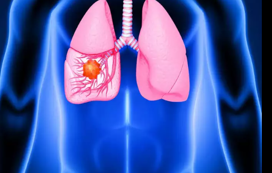 Tháng 10 năm ngoái, Lý Thiến Sơn bị ho kéo dài. Lúc đầu, cô nghĩ bản thân bị cảm lạnh, lại thức khuya liên tục khiến cơ thể suy nhược, bệnh khó lành. Trong thời gian này, Lý Thiến Sơn không đi khám, chỉ mua thuốc về uống. Ảnh: Boldsky.