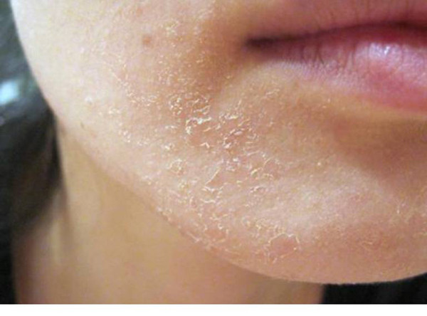 Da thô ráp. Vitamin là chất hữu cơ giúp duy trì sức khỏe, tham gia cấu tạo tế bào, chuyển hóa thức ăn thành năng lượng... Thiếu vitamin, cơ thể khó vận hành bình thường, biểu hiện ra ngoài là tình trạng da thô ráp, nổi mụn. Để da khỏe đẹp, chế độ ăn uống cần bổ sung vitamin B, C, E... Chỉ khi cung cấp đủ vitamin, mao mạch dưới da mới thông thoáng, cung cấp đủ dinh dưỡng cho da, đảm bảo da khỏe mạnh. (Ảnh minh họa)