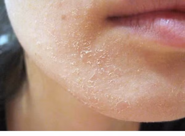 Da thô ráp. Vitamin là chất hữu cơ giúp duy trì sức khỏe, tham gia cấu tạo tế bào, chuyển hóa thức ăn thành năng lượng... Thiếu vitamin, cơ thể khó vận hành bình thường, biểu hiện ra ngoài là tình trạng da thô ráp, nổi mụn. Để da khỏe đẹp, chế độ ăn uống cần bổ sung vitamin B, C, E... Chỉ khi cung cấp đủ vitamin, mao mạch dưới da mới thông thoáng, cung cấp đủ dinh dưỡng cho da, đảm bảo da khỏe mạnh. (Ảnh minh họa)