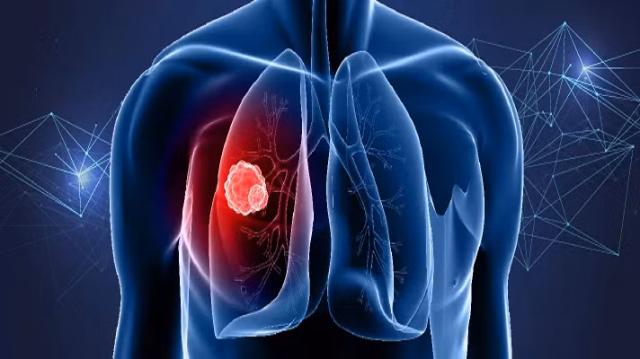 Khi nhắc đến bệnh ung thư phổi, đầu tiên nhiều người sẽ nghĩ ngay đến các triệu chứng như ho, khó thở, ho ra máu,… Tuy nhiên, căn bệnh này có thể di căn ở một số vị trí khác trong cơ thể. (Ảnh: wcrf.org)