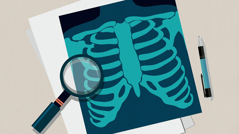 Nhiều người có tâm lý rằng có triệu chứng mới đi khám, không có triệu chứng thì bỏ qua. Nhưng, ung thư phổi giai đoạn đầu có thể hoàn toàn không có triệu chứng. (Ảnh: Everydayhealth)