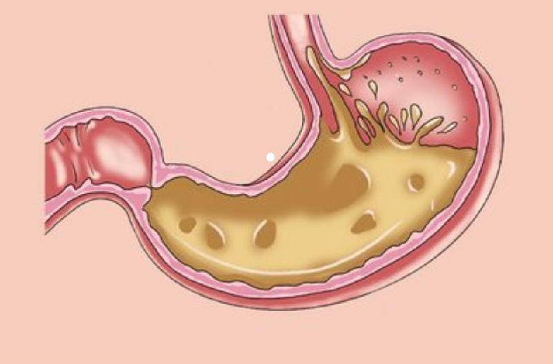 Đi khám, bác sĩ chẩn đoán bệnh nhân mắc viêm loét dạ dày, cần tích cực điều trị, thay đổi thói quen ăn uống. Nếu không, tình trạng sẽ ngày càng tiến triển xấu. Ảnh: ABLW.