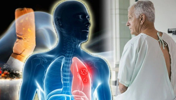 Lý giải về việc nam giới dễ mắc ung thư hơn phụ nữ, bác sĩ Yang Mu làm việc tại Bệnh viện Ung thư Tứ Xuyên cho biết có một số lý do sau. (Ảnh: Dantri) 