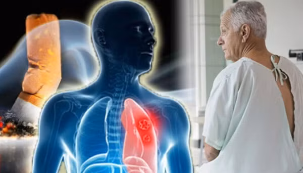 Lý giải về việc nam giới dễ mắc ung thư hơn phụ nữ, bác sĩ Yang Mu làm việc tại Bệnh viện Ung thư Tứ Xuyên cho biết có một số lý do sau. (Ảnh: Dantri) 