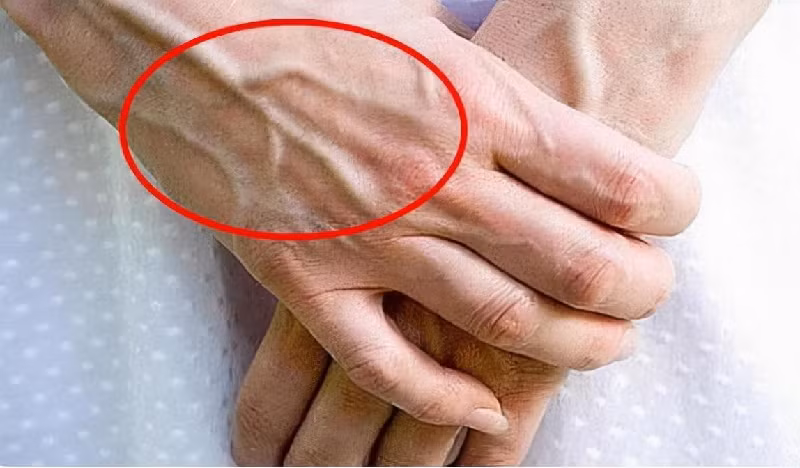 Nổi gân xanh ở 3 bộ phận này, khám ngay kẻo hối không kịp Noi gan xanh o 3 bo phan nay, kham ngay keo hoi khong kip