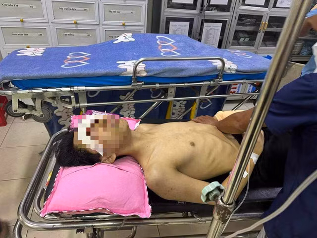  Nam sinh lớp 11 bị thương nghi do nổ bình gas mini: Ngày 1/8, người dân ở thôn 3 (xã Phúc Đồng, huyện Hương Khê, Hà Tĩnh) bất ngờ nghe tiếng nổ phát ra từ nhà của gia đình em Võ Tuấn T. (17 tuổi, ngụ tại thôn 3, xã Phúc Đồng; vừa học xong lớp 11 Trường THPT Hàm Nghi, huyện Hương Khê). Khi đến nơi, người dân phát hiện em T. bị dập nát bàn tay trái, 2 mắt bị tổn thương nặng và đang kêu cứu tại khu vực nhà bếp. Nguyên nhân ban đầu được xác định có thể là do bình gas mini phát nổ trong lúc em này nấu ăn. 