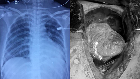 Hình ảnh trái tim bị tổn thương của bệnh nhân