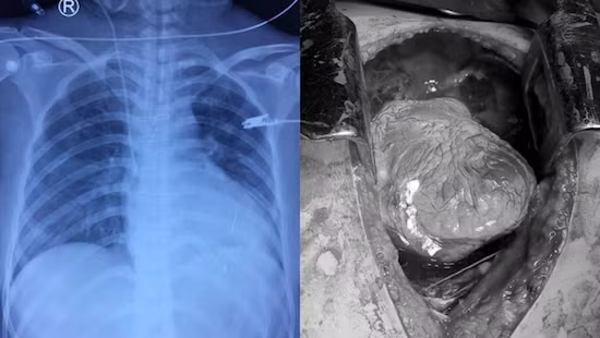 Hình ảnh trái tim bị tổn thương của bệnh nhân