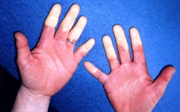 10 căn bệnh của mùa Đông mà ai cũng có thể mắc phải - Hình 9 10 can benh cua mua Dong ma ai cung co the mac phai-Hinh-9