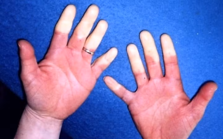 10 can benh cua mua Dong ma ai cung co the mac phai-Hinh-9